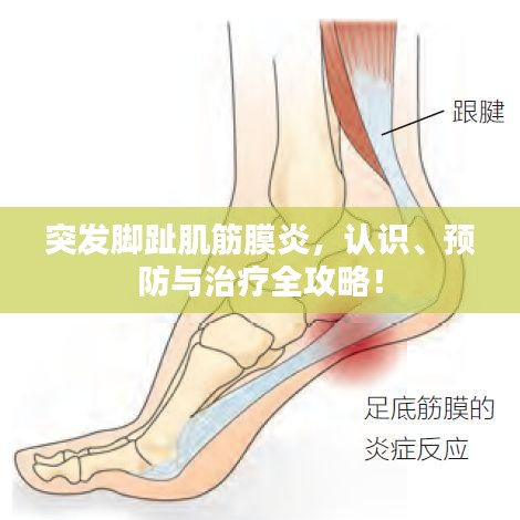 突發(fā)腳趾肌筋膜炎，認識、預(yù)防與治療全攻略！